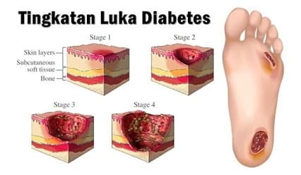 penyakit luka diabetes-min