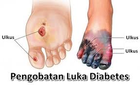 luka diabetes-min(1)